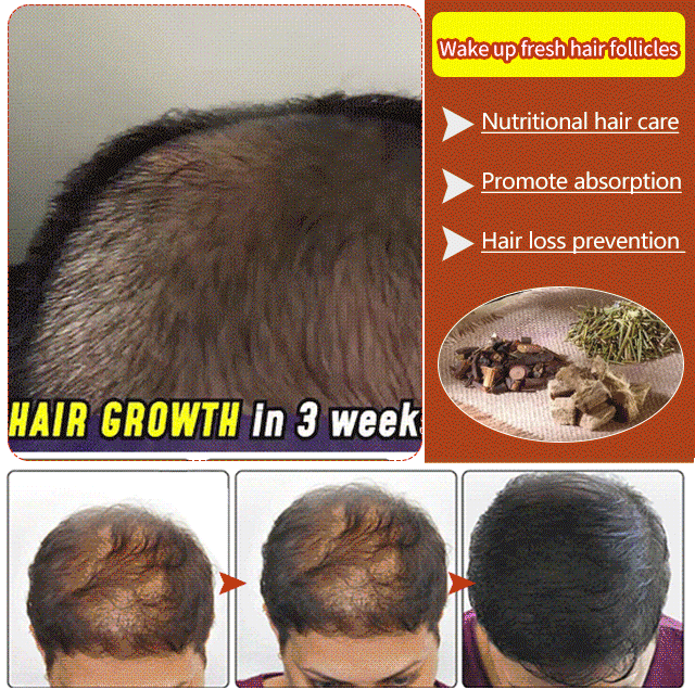 š„Polygonum Multiflorum Roller Massage Hair Regrowth SerumćBuy 1 Get 1 Freeć